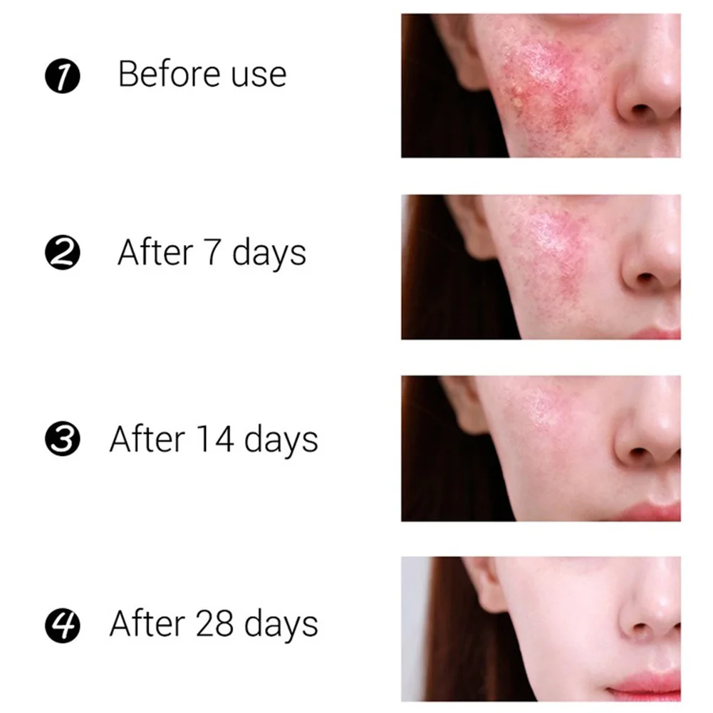 VOVA Cicatrice Acnee Îndepărtarea Crema de vergeturi, Cosuri Gel Facial Elimina Acnee Netezire, Hidratare, Albire Organism de Îngrijire a Pielii TSML1