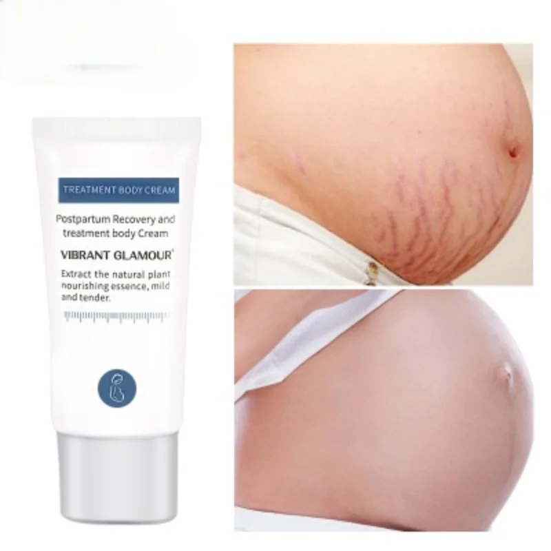 Mango Remove Pregnancy Scars Acne Cream Stretch Marks Treatment Maternity Repair Anti-Aging Anti